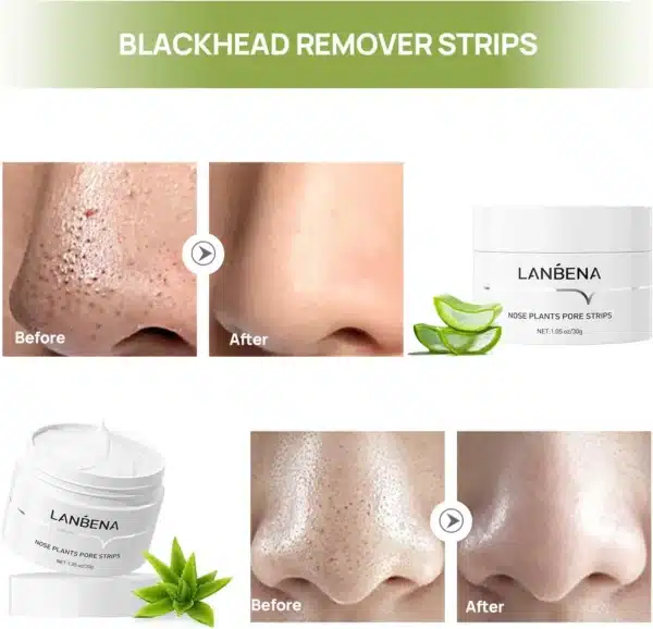 Lanbena Blackheads Removal Nose Plants Pore Strips - Image 2